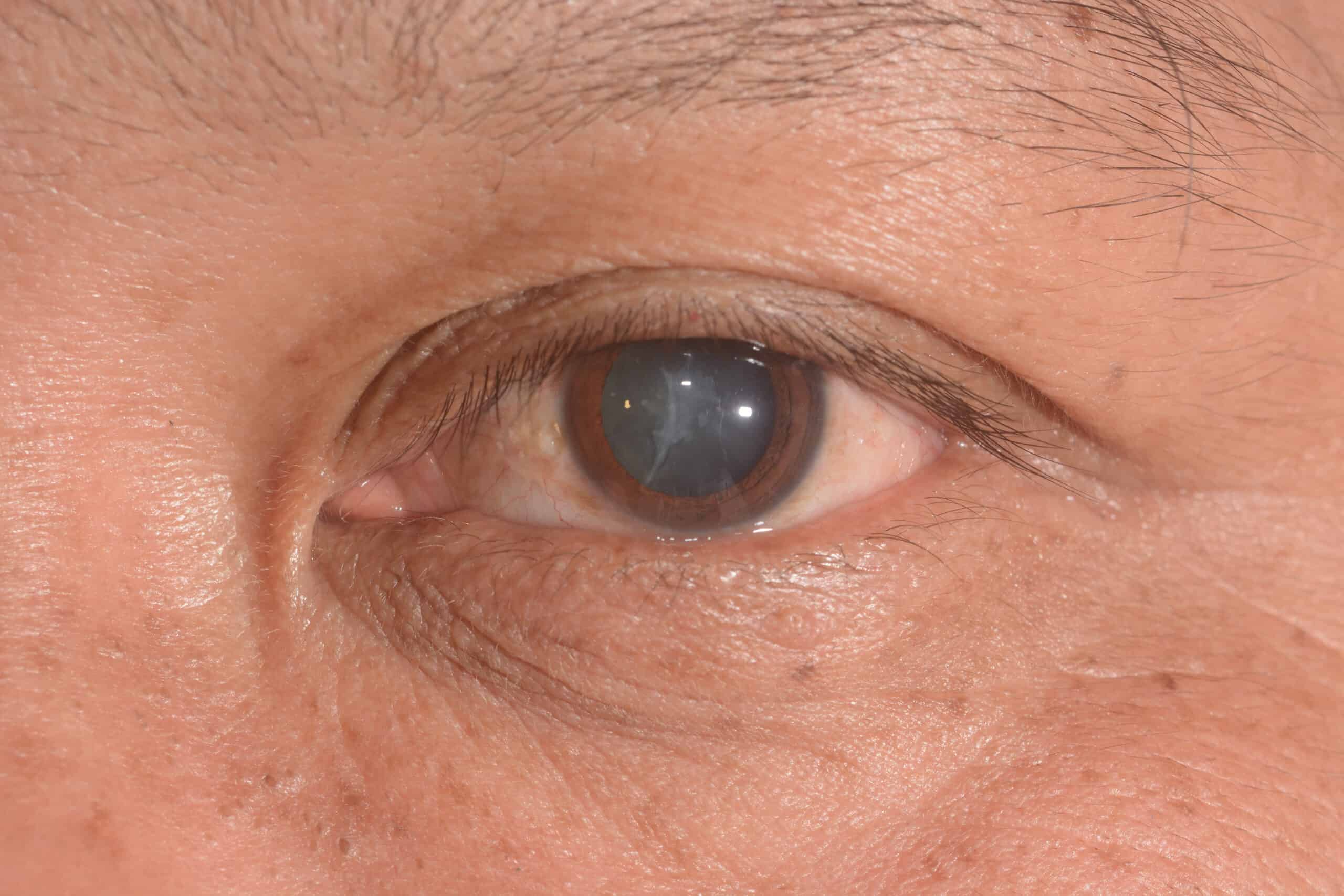 Close up with an eye with cateract